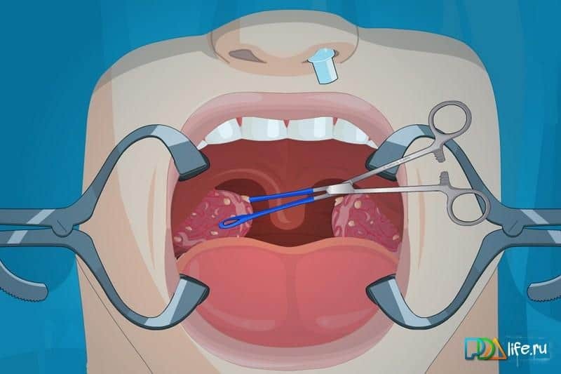 Operate Now: Tonsil Surgery